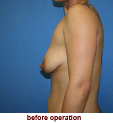 plastic-surgery-breast-lift-augmentation